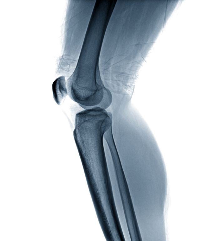 Knee X-ray